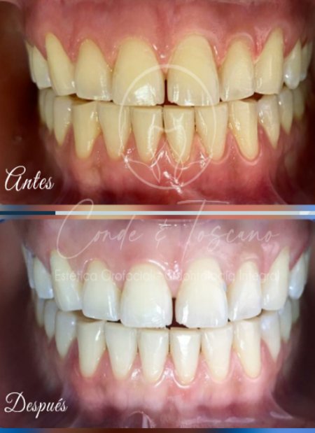 Aclaramiento dental